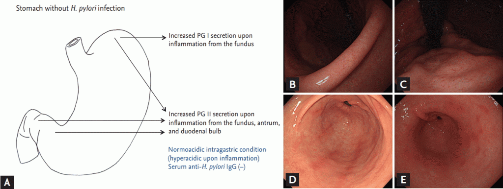 Figure 2.(A) Endoscopic findings in subjects without Helicobacter pylori infection. Pepsinogen (PG) I is produced exclusively by chief cells and mucus neck cells on the fundus. PG II is secreted throughout the stomach and also from the Brunner’s gland of the duodenal bulb. (B) Normal endoscopic finding of the angle in noninfected subject. The regular arrangement of the collecting venules on the angle indicate normal gastric mucosa. (C) Normal finding of the corpus in the same subject. The regular arrangement of the collecting venules extends up to the on the cardia and fundus. (D) Chronic superficial gastritis. Several hyperemic streaks are noticed on greater curvature side of the antrum. (E) Erosive gastritis. Multiple raised, hyperemic erosions are visible on the antrum.