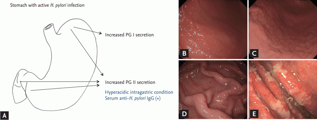 Figure 3.(A) Endoscopic findings in subjects with active Helicobacter pylori infection. (B) Nodular gastritis on the anterior-greater side of the proximal antrum. Multiple small nodules are visible on the antrum, extending up to greater curvature side of the corpus. The nodules consist of submucosal elevated lesions, and thus, there is no color change in nodular gastritis. (C) Follow-up findings of enlarged nodules on the proximal antrum to low-body in the same patient. The previously noted tiny, regular nodules have increased in size. The nodules were irregular and had grown from 12 months prior. (D) Finding of hemorrhagic spots on the fundus in nodular gastritis patient at initial endoscopy (B). Multiple tiny reddish spots, so-called diffuse redness, can be seen on the fundus and greater curvature side of the corpus. (E) Hypertrophic gastric folds. Thickened gastric rugae with whitish, sticky exudates indicate active H. pylori infection. PG, pepsinogen.