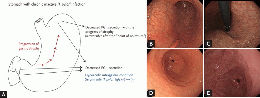 Figure 4. (A) Endoscopic findings in subjects with chronic Helicobacter pylori infection. Therefore, the serum pepsinogen (PG) I level is decreased only when the fundus is damaged by atrophic changes. Based on these findings, gastric corpus atrophy is defined as a serum PG I/II ratio of < 3.0 and a PG I level of < 70 ng/mL, and is widely used for gastric cancer screening for the detection of high risk individuals. (B) Closed-type atrophic gastritis. Visible transparent vessels can be seen on the anterior-lesser curvature side of the low-body to the angle. An atrophic border is present. (C) Open-type atrophic gastritis. Visible transparent vessels are extended up to the cardia without an atrophic border. (D) Metaplastic gastritis. Multiple large, irregular whitish elevations are present on the distal part of the antrum. This is a common endoscopic finding in subjects with atrophic gastritis on the corpus. (E) Diffuse, irregular whitish changes in metaplastic gastritis. Intestinal metaplasia can have a variety of appearances, such as whitish, nodular elevations. Geographic and hyperemic changes can be also found in metaplastic gastritis.