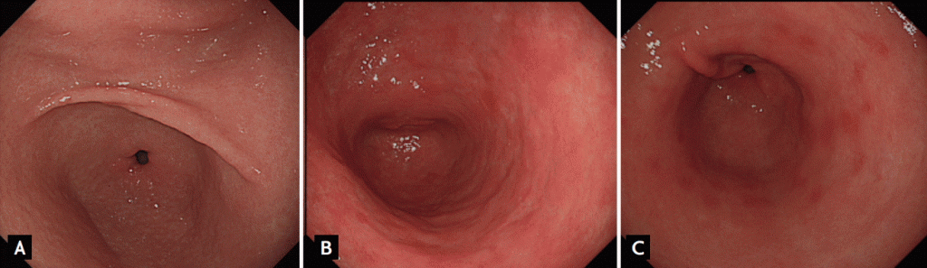 Figure 5. Different endoscopic findings of nodular gastritis, metaplastic gastritis, and erosive gastritis. (A) Nodular gastritis. On the distal part of the antrum, multiple elevated nodules are seen without color change. The nodules are regular in size and shape. (B) Metaplastic gastritis. Intestinal metaplasia can be confused when hyperemic mucosa is augmented by whitish surrounding mucosa. The elevations are irregular in size, shape, and color. (C) Erosive gastritis. Elevated hyperemic erosions are scattered on the antrum