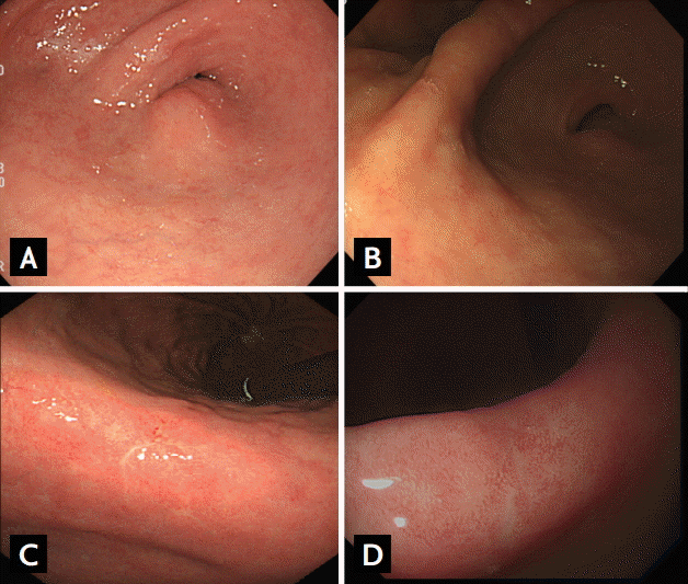 Figure 6. Different prognoses in two Helicobacter pylori-infected subjects. (A) Endoscopic findings of a 55-year-old man. A single, raised erosion is present on the greater curvature side of the pylorus. A serum anti-H. pylori immunoglobulin G (IgG) assay was positive on the day of endoscopic examination. The serum pepsinogen (PG) I level was 25.8 ng/mL, the PG II level was 12.2 ng/mL, and the PG I/II ratio was 2.1 (normal values: PG I > 70.0 ng/mL, PG II < 15.0 ng/mL, PG I/II ratio > 3.0). Pathology test results revealed chronic gastritis with marked intestinal metaplasia, and Giemsa staining was negative. (B) Forty-three months after the initial tests. The patient revisited our clinic for follow-up testing. The serum anti-H. pylori IgG assay was still positive, and the serum PG I level and PG I/II ratio had decreased (PG I 24.0 ng/mL, PG II 13.0 ng/mL, PG I/II ratio 1.8). Pathology test results and Giemsa staining were not altered. (C) Endoscopic findings of a 62-year-old man. The serum anti-H. pylori IgG assay was positive, and the serum PG assay finding was also positive (PG I 28.6 ng/mL, PG II 14.5 ng/mL, PG I/II ratio 2.0). Active gastritis with foveolar hyperplasia and regenerated glands were found on the biopsy, and Giemsa staining was positive. (D) Follow-up endoscopy 1 year after successful H. pylori eradication. The serum anti-H. pylori IgG test became negative, and the serum PG I/II ratio had increased (PG I 29.0 ng/mL, PG II 10.4 ng/mL, PG I/II ratio 2.7). Pathology test results revealed chronic gastritis without H. pylori-like microorganisms, and Giemsa staining was negative.
